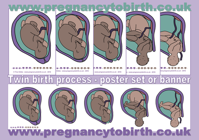 twin birth process posters